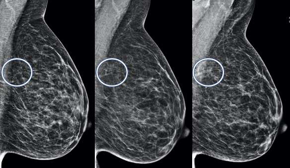 Breast Asymmetry Radiology Ucla Health