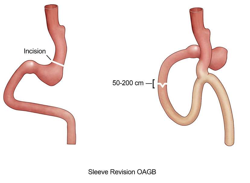 Sleeve Weight Regain - Bariatric Surgery | UCLA Health