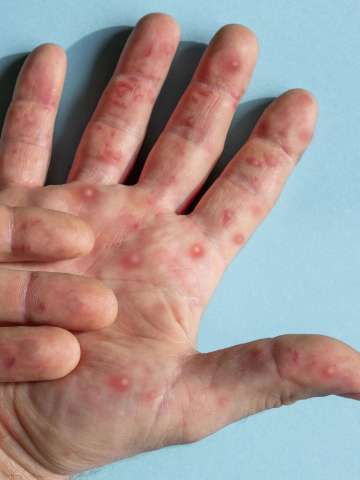 What to Do If You Think You Have Monkeypox Symptoms, According to Experts