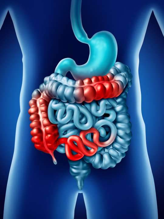 Inflammatory Bowel Disease - Los Angeles, CA | UCLA Health