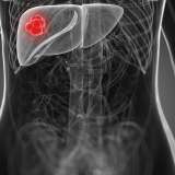 Tumor on liver